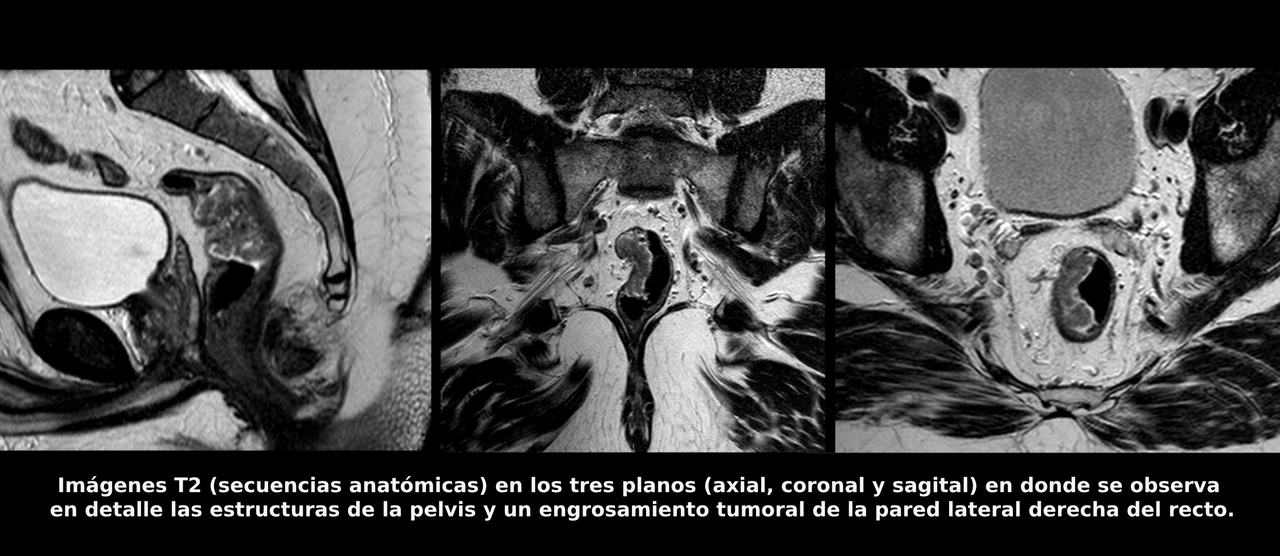 UNA MIRADA DETALLADA AL CÁNCER DE RECTO: LA RESONANCIA DE ALTA ...